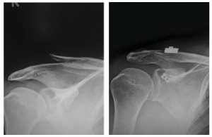 AC Joint Surgery Before and After