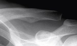 Grade 3 AC Joint Separation X-Ray
