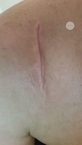 patient's shoulder after AC Joint Surgery