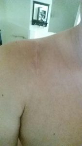 healed patient's shoulder after AC Joint Surgery