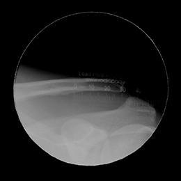 Grade 3 AC Joint Separation measured x-ray