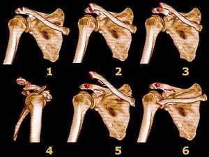 ac joint separation grading