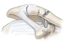 AC Joint Repair Technique