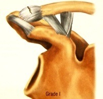 AC Joint Separation Grade 1