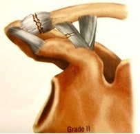 AC Joint Separation Grade 2