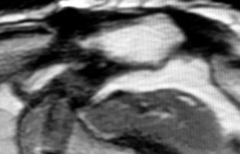 case 1 MRI 9 years After AC Joint Repair Surgery