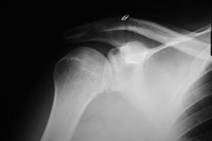 case 1 Postoperative AC Joint X-ray