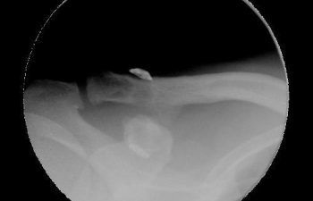Case 10 Final Postoperative AC Joint X-ray