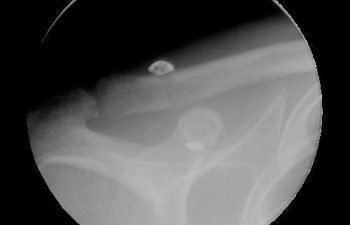 Case 10 Postoperative AC Joint X-ray