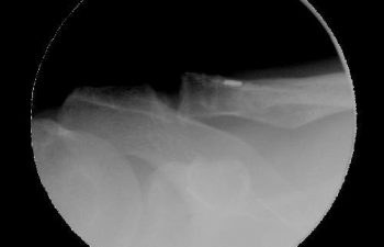 Case 12 Final Postoperative AC Joint X-ray