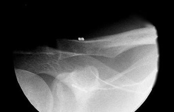 Case 12 Postoperative AC Joint X-ray