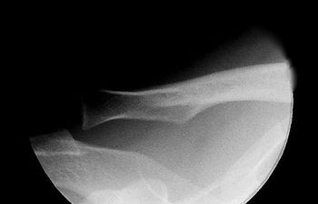 Case 12 Preoperative AC Joint X-ray