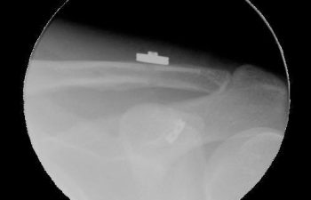 Case 14 Post Postoperative AC Joint X-ray