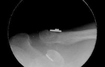 Case 15 Post Postoperative AC Joint X-ray