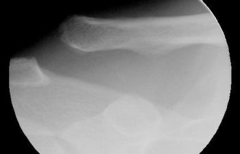 Case 15 Preoperative AC Joint X-ray