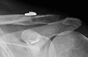 Case 16 Postoperative AC Joint X-ray