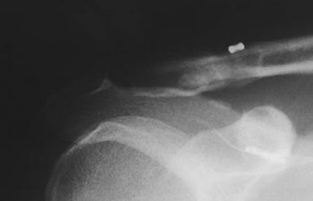 Case 2 Final Postoperative AC Joint X-ray