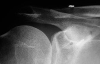 Case 2 Postoperative AC Joint X-ray