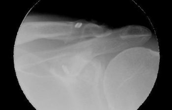 Case 3 Final Postoperative AC Joint X-ray