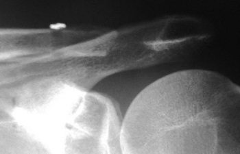 Case 3 Postoperative AC Joint X-ray