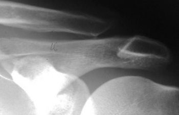 Case 3 Preoperative AC Joint X-ray