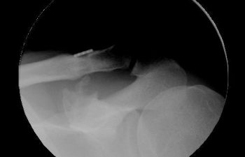 Case 4 Final Postoperative AC Joint X-ray