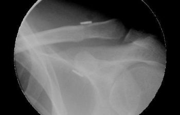 Case 4 Postoperative AC Joint X-ray