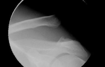 Case 4 Preoperative AC Joint X-ray