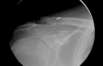 Case 5 Final Postoperative AC Joint X-ray