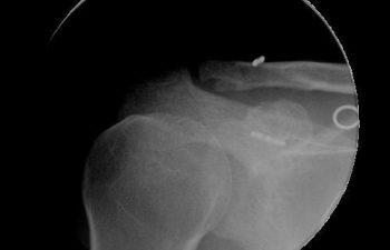 Case 5 Postoperative AC Joint X-ray