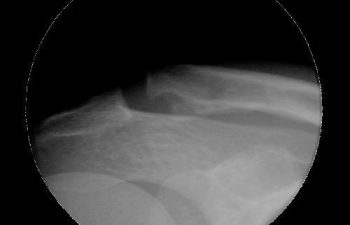 Case 5 Preoperative AC Joint X-ray