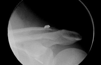 Case 6 Postoperative AC Joint X-ray