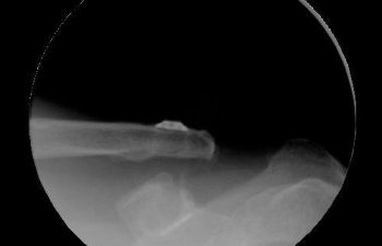 Case 7 Final Postoperative AC Joint X-ray