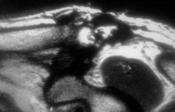 Case 7 Final Postoperative AC Joint MRI