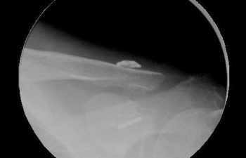 Case 7 Postoperative AC Joint X-ray