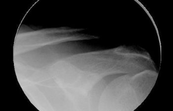 Case 7 Preoperative AC Joint X-ray