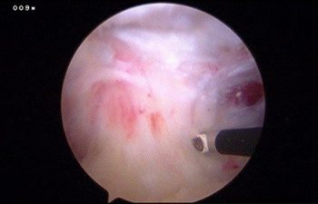 Case 8 AC Joint arthroscopic photo 1