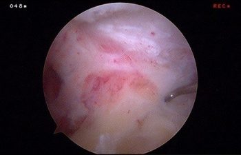 Case 8 AC Joint arthroscopic photo 2