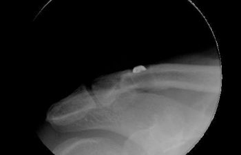 Case 8 Final Postoperative AC Joint X-ray