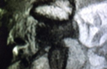 Case 8 AC Joint MRI