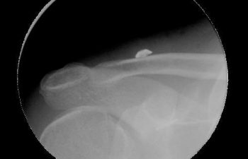 Case 8 Postoperative AC Joint X-ray