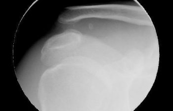 Case 8 Preoperative AC Joint X-ray