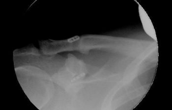 Case 9 Final Postoperative AC Joint X-ray