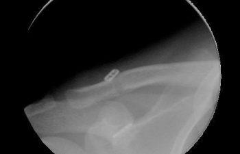 Case 9 Postoperative AC Joint X-ray