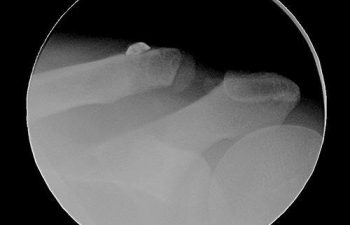 Case 6 Final Postoperative AC Joint X-ray