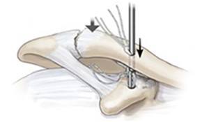 Endobutton Passage