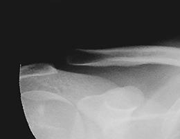 Grade 2 AC Joint Separation