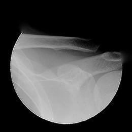 Grade 3 Shoulder Separation x-ray