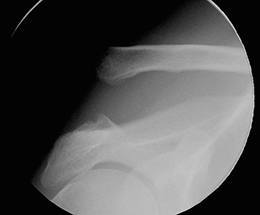 Can AC Joint Separation be Treated Without Surgery?