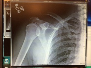 AC Joint injured shoulder